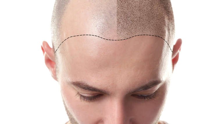 Male Treatments