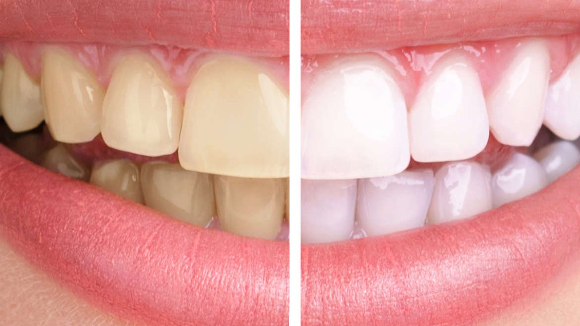 Teeth Whitening Treatments Facial Secrets Advanced Aesthetics Torbay